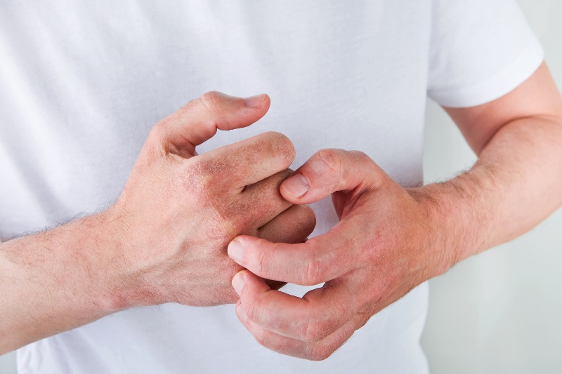 A man scratching his hands that have eczema by Swinyer Woseth Dermatology