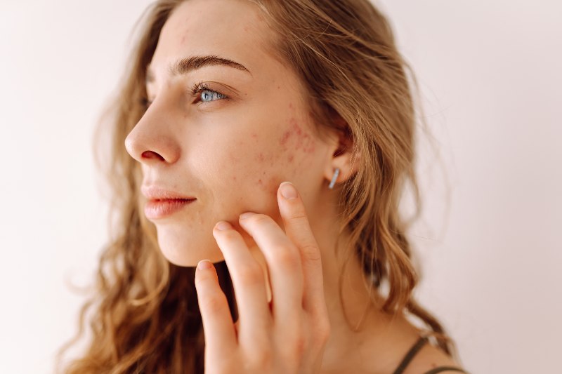 A woman touching her acne scars on her face by Swinyer Woseth Dermatology
