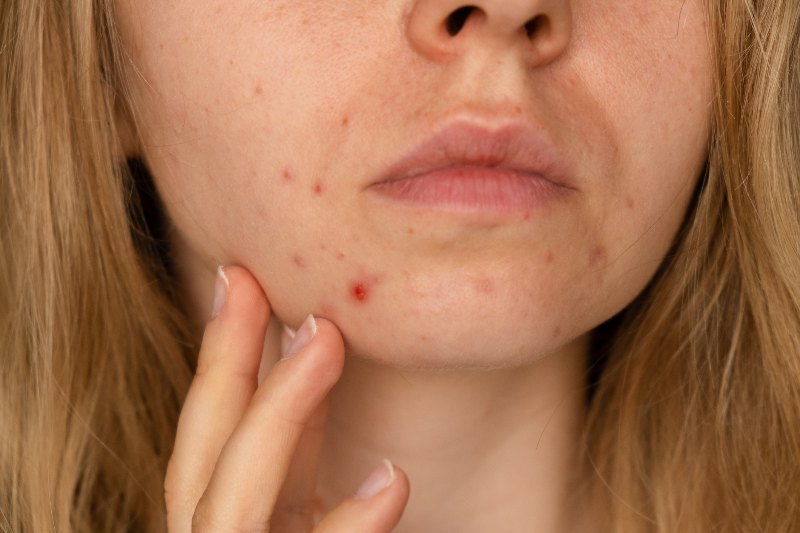 A woman touching her skin with post-acne hyperpigmentation by Swinyer Woseth Dermatology
