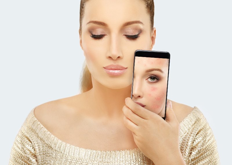 A woman holding a phone by her face with before and after rosacea by Swinyer Woseth Dermatology