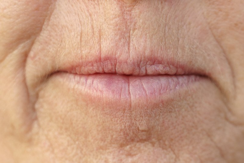A close-up of someone’s mouth with smoker’s lines by Swinyer Woseth Dermatology
