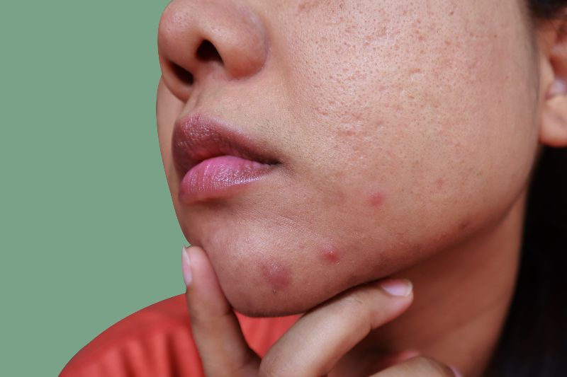 Close-up of a woman’s face with cystic acne by Swinyer Woseth Dermatology