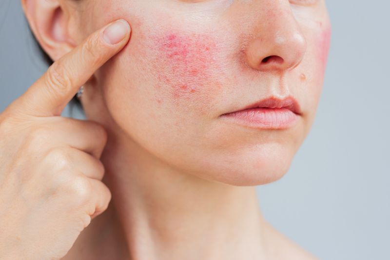 A woman points to some rosacea on her cheek by Swinyer Woseth Dermatology