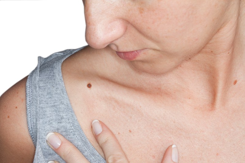 A woman looking at a potential melanoma on her shoulder by Swinyer Woseth Dermatology