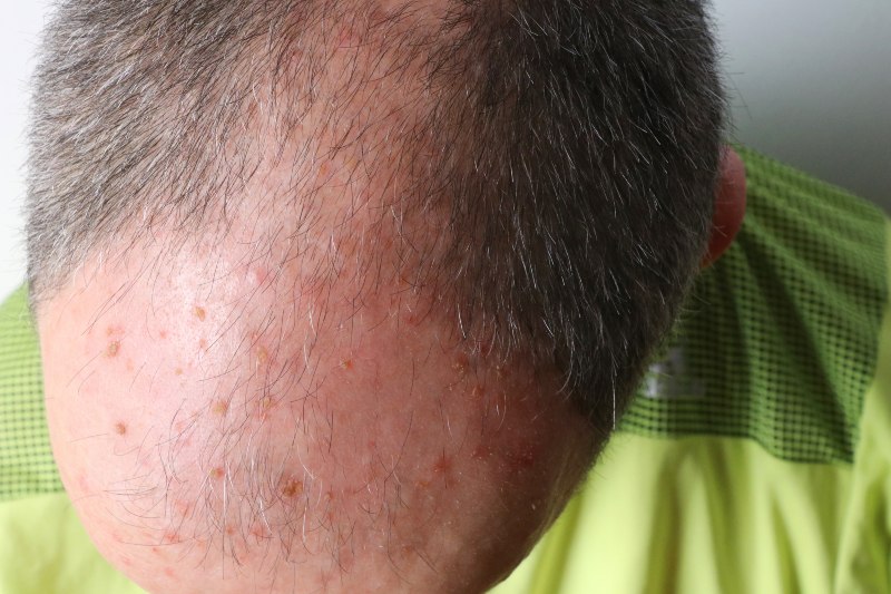A close-up of a man’s head to show actinic keratosis by Swinyer Woseth Dermatology