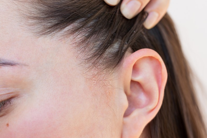 A woman with seborrheic dermatitis, pulling her hair back by her ear by Swinyer Woseth Dermatology