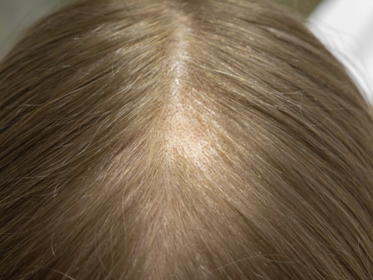 A close-up of a woman’s scalp with telogen effluvium, needing help from Swinyer Woseth Dermatology