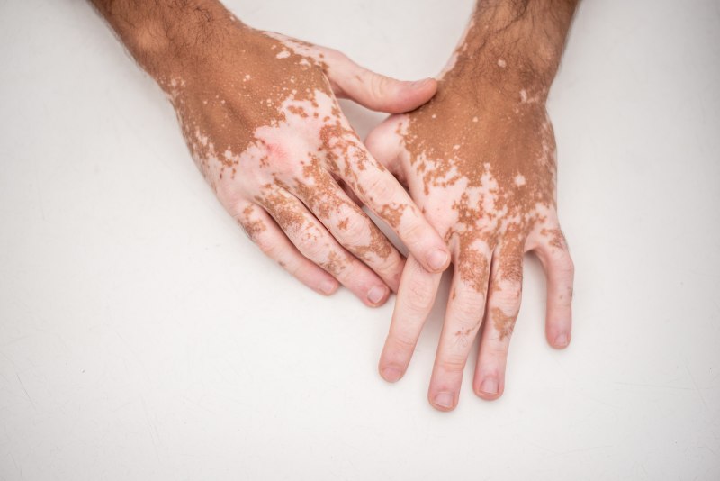 Vitiligo being shown on someone’s hands by Swinyer Woseth Dermatology